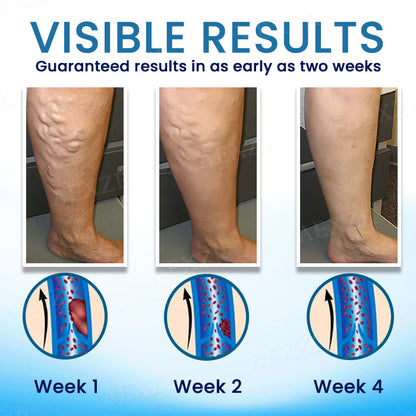Cvreoz® Herbal Varicose Veins Treatment Spray