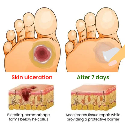 Cvreoz® Diabetes Treatment Cream