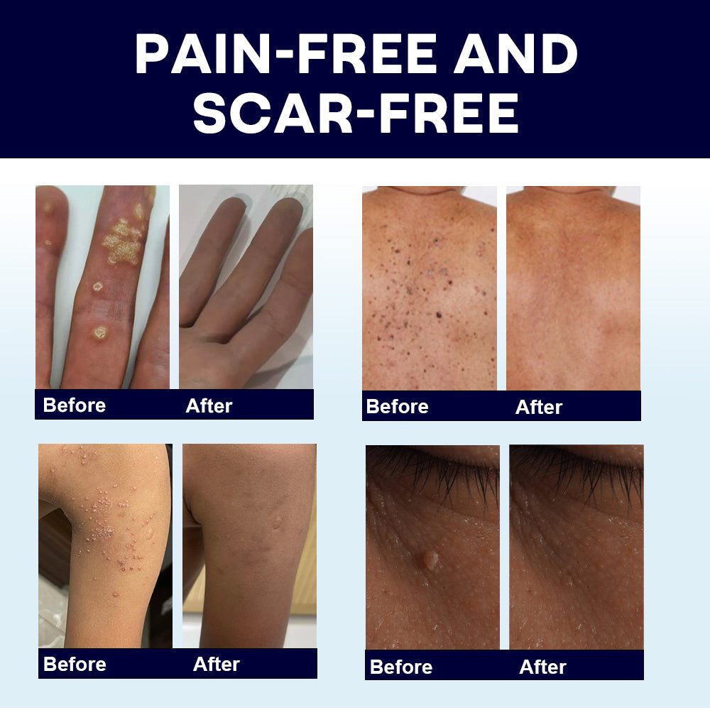 🔥Cyber Monday Sale🔥 | AAFQ® WartLock CRYO RECOVERY SPRAY