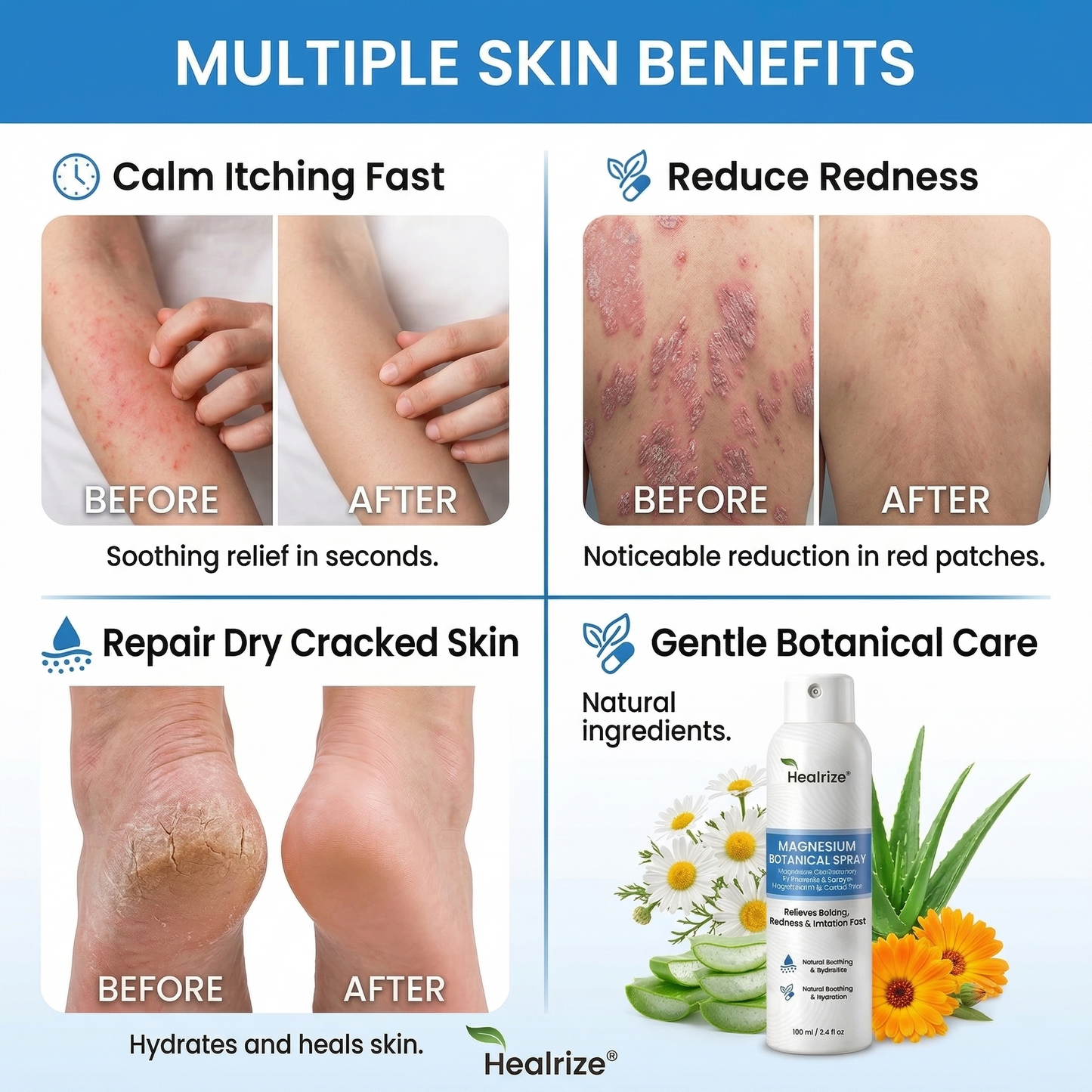 🇺🇸 Official Store| Healrize® Magnesium Botanical Spray – 🥇 Fast Relief for Psoriasis & Eczema | No Rubbing, Steroid-Free