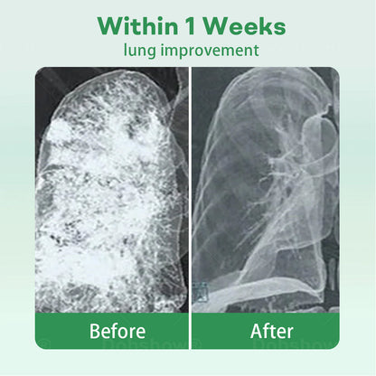 ✅Official Store| 𝐂𝐯𝐫𝐞𝐨𝐳® 𝐇𝐞𝐫𝐛𝐚𝐥 𝐋𝐮𝐧𝐠 𝐂𝐥𝐞𝐚𝐧𝐬𝐢𝐧𝐠 𝐈𝐧𝐡𝐚𝐢𝐞𝐫(🫁Cough, wheezing, shortness of breath, sputum, stuffy nose, bronchitis, bronchitis, allergy symptoms, lung discomfort💝)