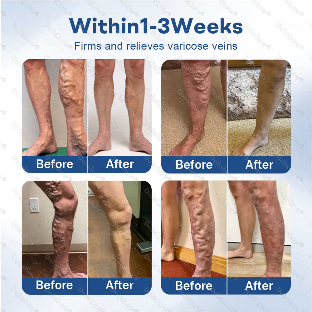 Healrize® DermaVein Microneedle Patch