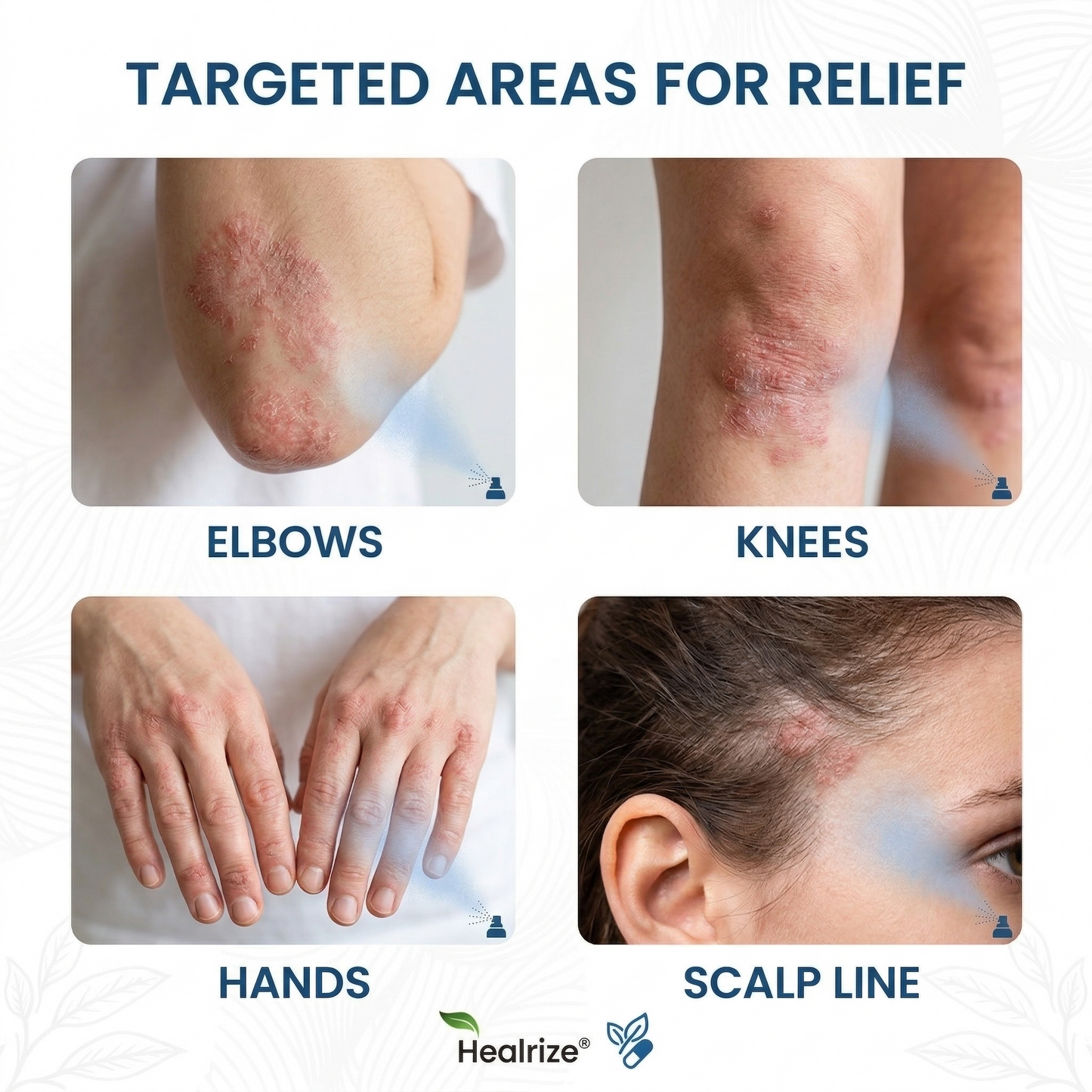 🇺🇸 Official Store| Healrize® Magnesium Botanical Spray – 🥇 Fast Relief for Psoriasis & Eczema | No Rubbing, Steroid-Free