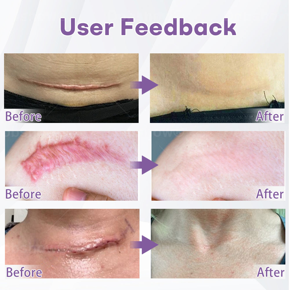 ✅ Complete skin confidence starts here Dobshow® NanoPenetrate Skin Renew Patch ✴️ Effective for all types of scars, stretch marks, blemishes, keloids, keratosis, acne, burns, warts, skin growths, and varicose veins.