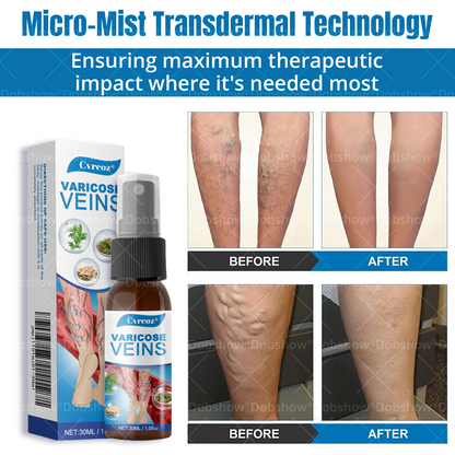 Cvreoz® Varicose Veins Comfort Spray