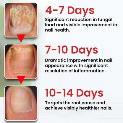 Dobshow® Fungi-Cure Max – Fast-Acting Relief for Fungal Nail Infections