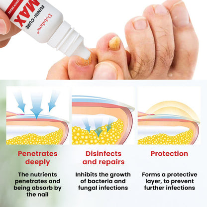 Dobshow® Fungi-Cure Max – Fast-Acting Relief for Fungal Nail Infections