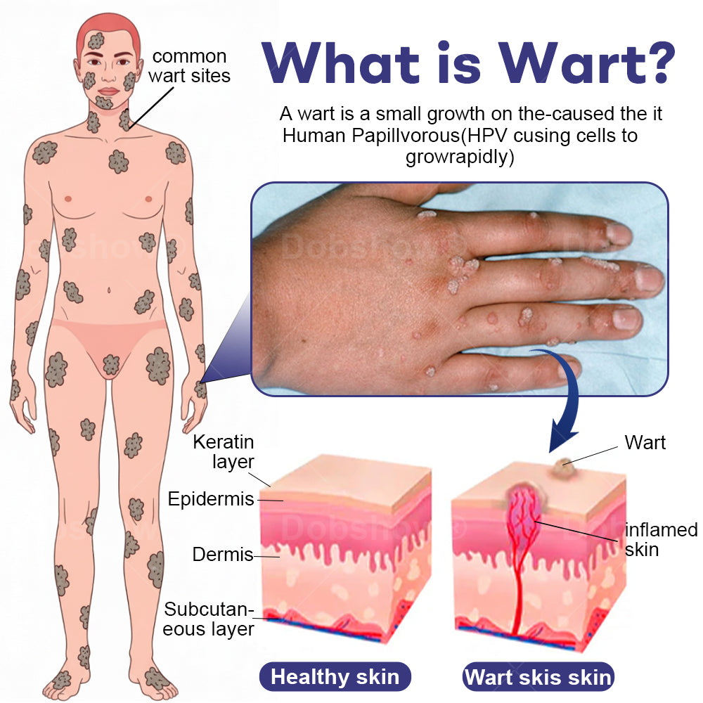🎅𝘾𝙝𝙧𝙞𝙨𝙩𝙢𝙖𝙨 𝙎𝙖𝙡𝙚  |  Cvreoz®  Wart Eraser Pro
