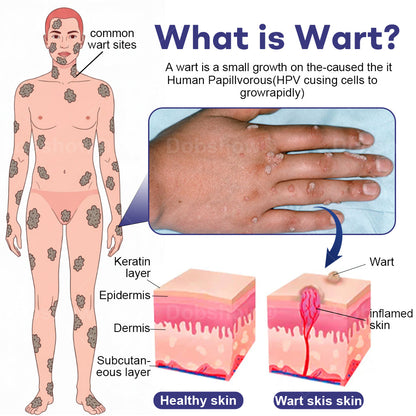 🎅𝘾𝙝𝙧𝙞𝙨𝙩𝙢𝙖𝙨 𝙎𝙖𝙡𝙚  |  Cvreoz®  Wart Eraser Pro