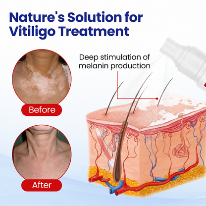 🔥 𝘽𝙚𝙨𝙩 𝙎𝙚𝙡𝙡𝙚𝙧 | Dobshow® Pigment Balance Spray– Targeted Vitiligo & White Patch Care | Supports Melanin Production, Pigment Balance & Natural-Looking Skin Tone