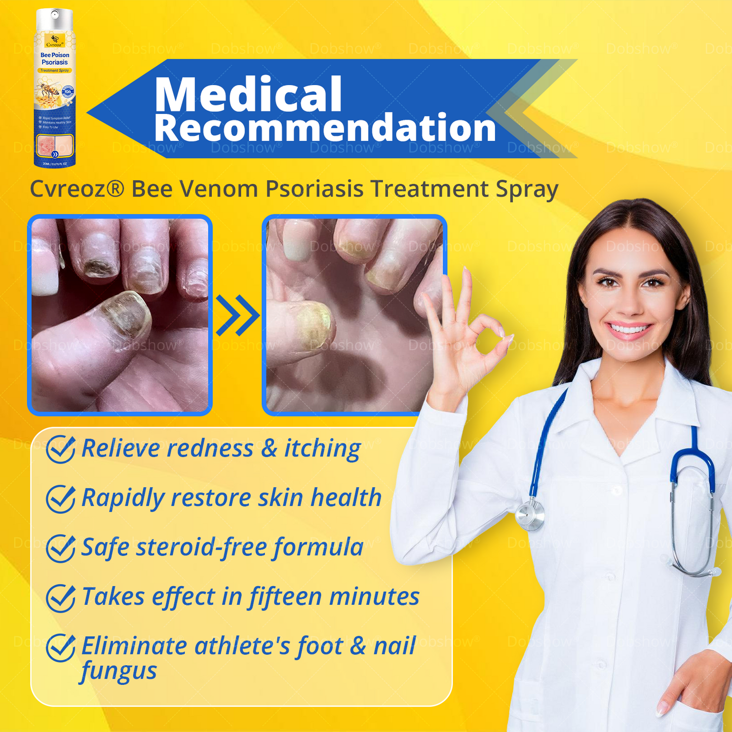 Cvreoz® Bee Venom Psoriasis Treatment Spray