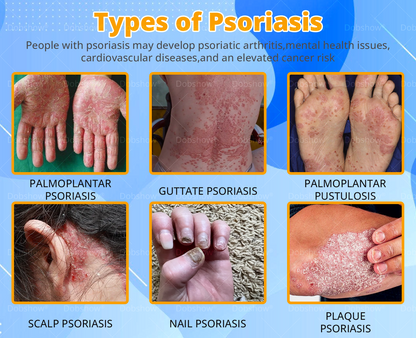 Cvreoz® Bee Venom Psoriasis Treatment Spray