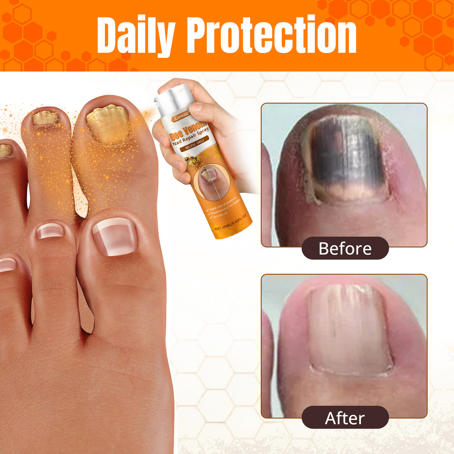 Cvreoz® Bee Venom Nail Repair Spray – Clinically Inspired Relief for Fungal & Damaged Nails👨‍⚕️